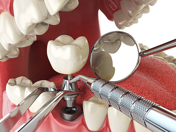 Best Emergency Tooth Extraction in Ripon, CA
