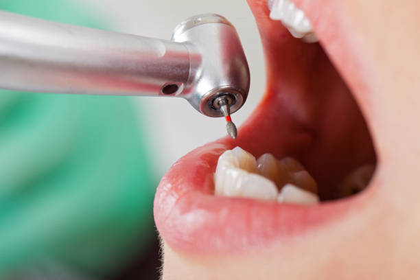 Best Emergency Dental Care for Broken or Chipped Teeth in Ripon, CA